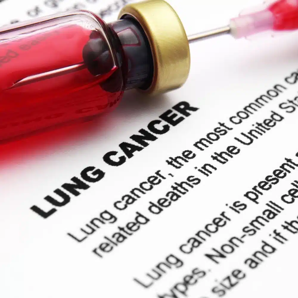lung cancer treatments