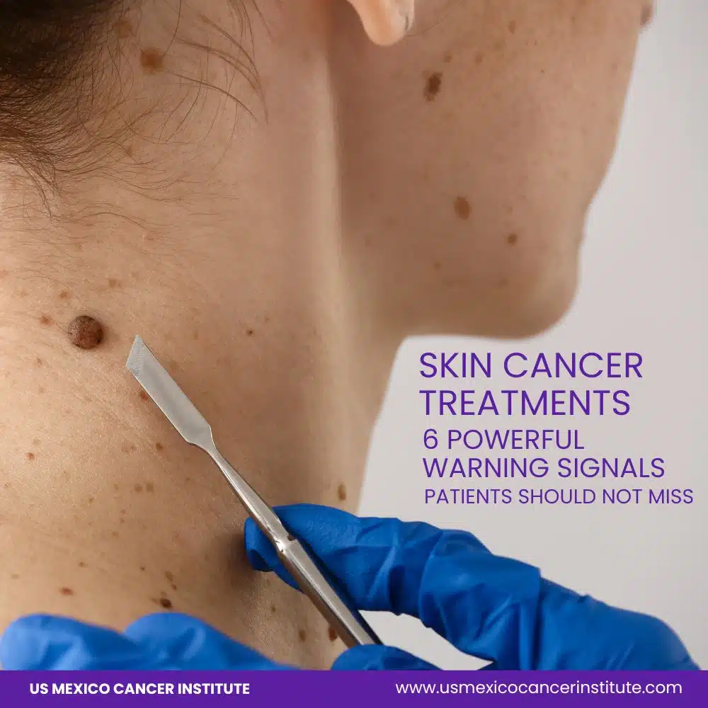 Skin Cancer Treatments 6 Powerful Warning Signals Patients Should Not Miss